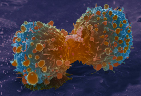 Làm thế nào để phát hiện và điều trị bệnh ung thư phổi?